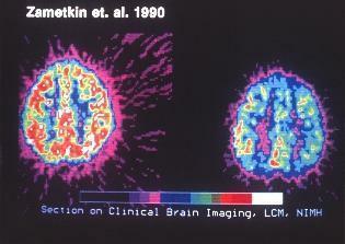 kliniczne skanowanie obrazowe mózgu w kierunku adhd