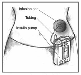 Pompa insulinowa