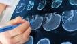 Skanowanie mózgu 3D może zwiększyć dokładność diagnozy ADHD